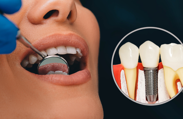 Why Should I Consider A Dental Implant To Replace My Missing Tooth?