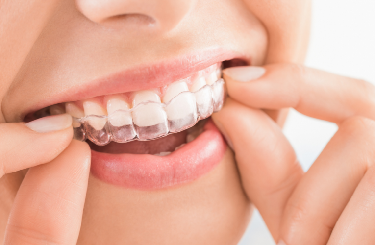 The Health Benefits of Straight Teeth with Clear Aligners