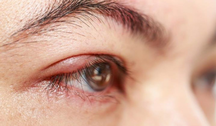 Can Removing a Mole on Your Eyelid Cause Cancer?
